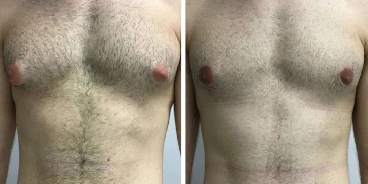 What Sets the Best Gynecomastia Surgeon in Dubai Apart from Other Specialists?