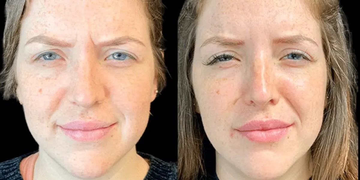 Best Plastic Surgeon in Dubai: Botox vs Fillers Guide