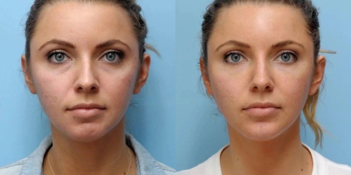Best Plastic Surgeon in Dubai: Thread Lift Treatments with Minimal Downtime