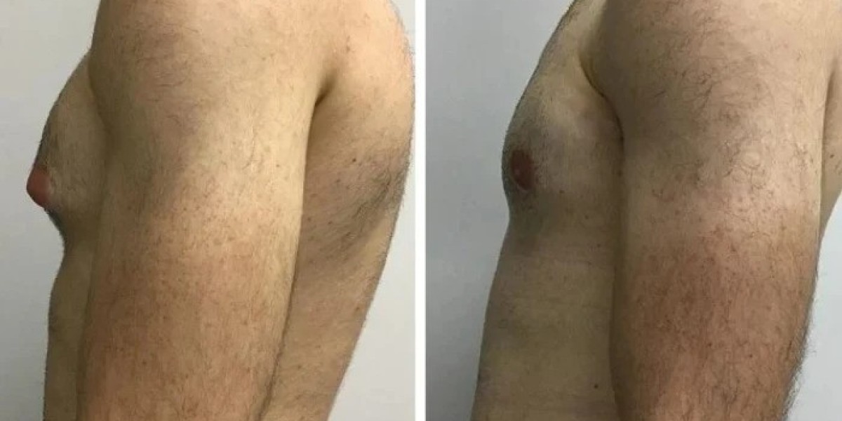 Gynecomastia in Dubai: Cosmetic Surgery Can Improve Physical Comfort, Self-Esteem