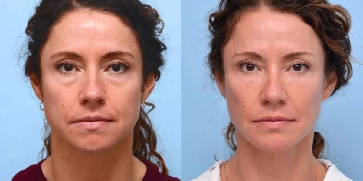 How to Select the Best Doctors in Dubai for Thread Lift Procedures