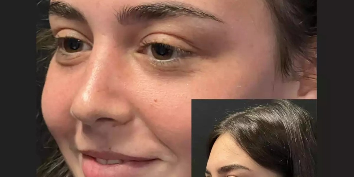 Why Is Rhinoplasty in Dubai a Smart Cosmetic Investment?