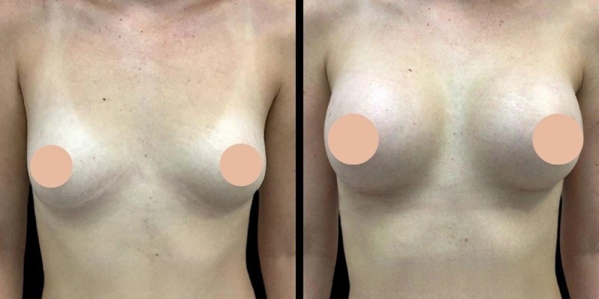 Breast Augmentation Surgery in Dubai: Week-by-Week Recovery