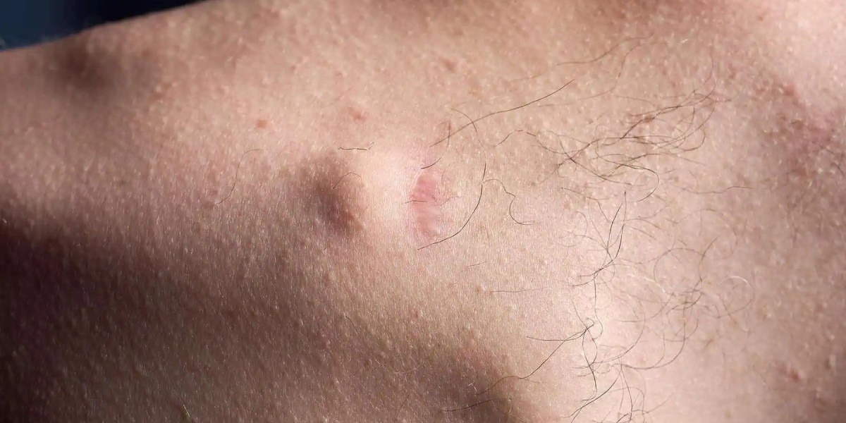 What Makes Lipoma Treatment in Dubai a Popular Choice?