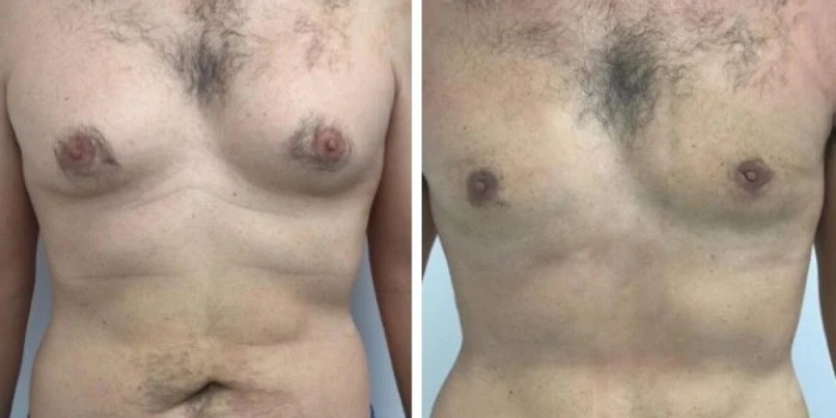 How Best Gynecomastia Surgeons in dubai Plan Tissue Removal