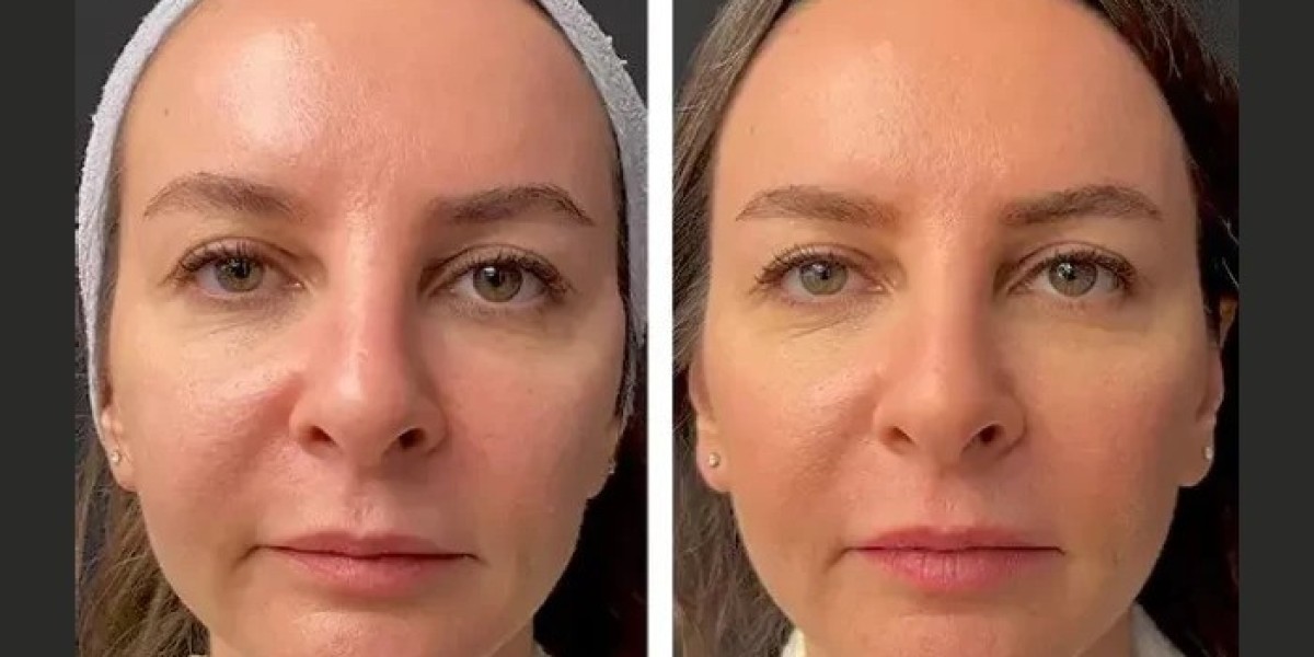 Best Plastic Surgeons in dubai for Mesotherapy Enlarged Pores