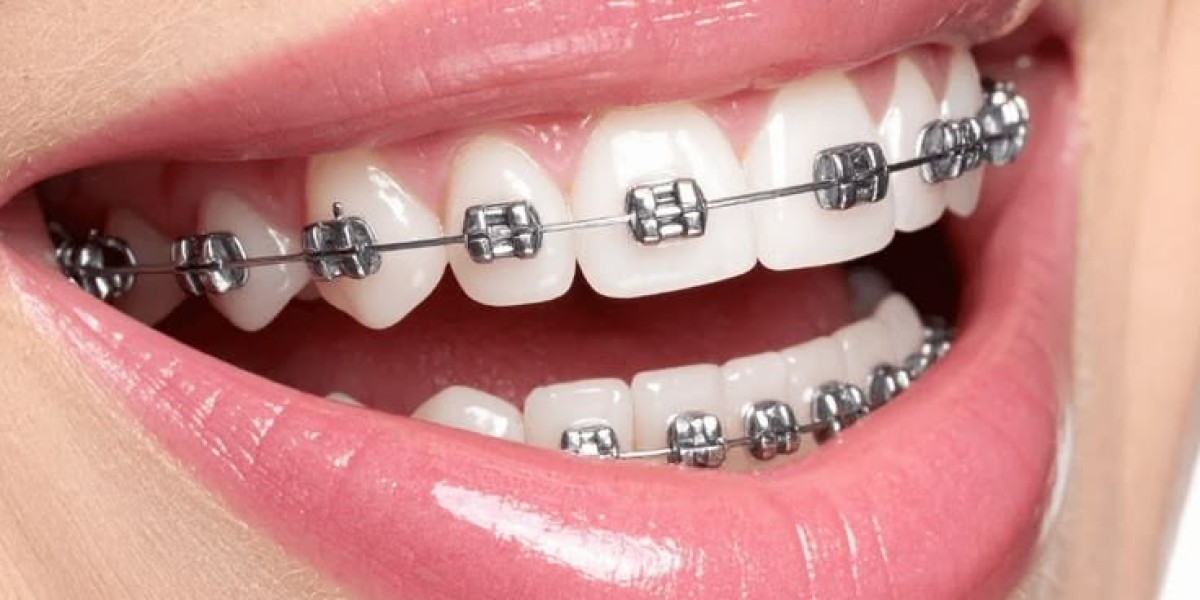 Smile Brighter With the Help of Dental Braces